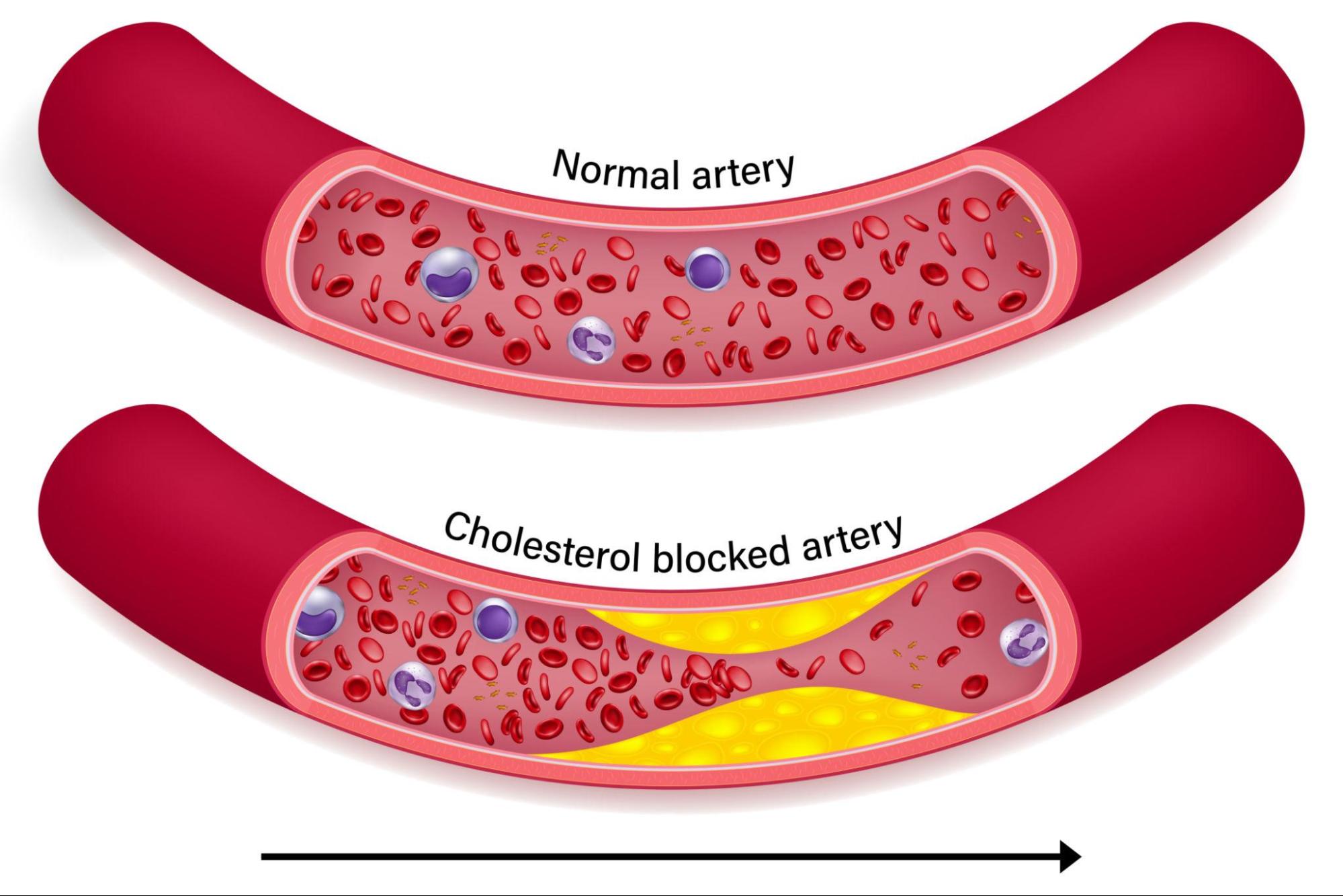 Cholesterol and heart health